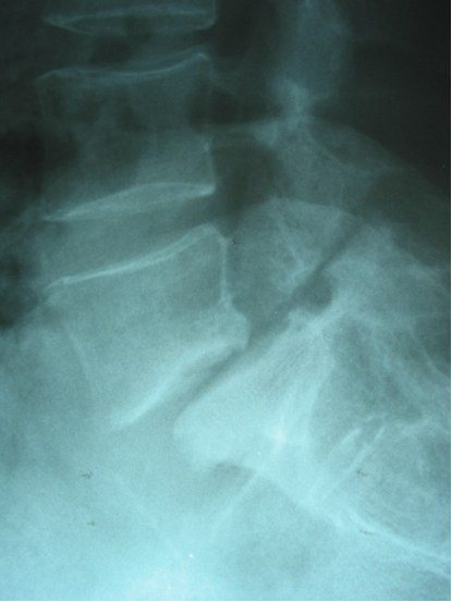 Stranski rentgenski posnetek petega ledvenega vretenca (L5)