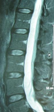 Normalna ledvena hrbtenica mlajšega moškega v stranski projekciji, preiskava z magentnoresonancnim tomografom. Vidna je segmentalna zgradba hrbtenice